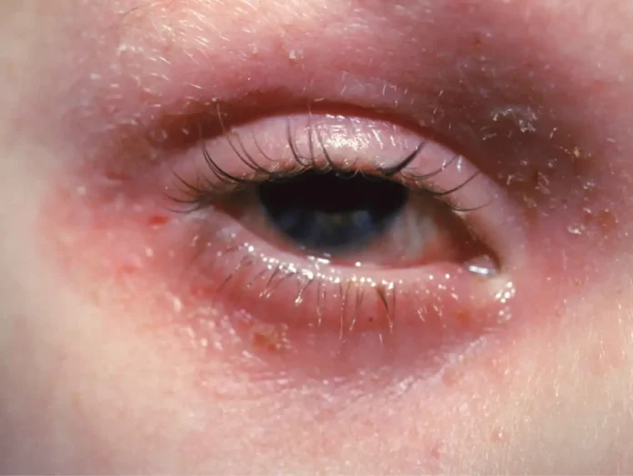 Allergic to Cold: Eczema Chronicles of a Young Dancer - Battling Allergies to Tears and Sweat
